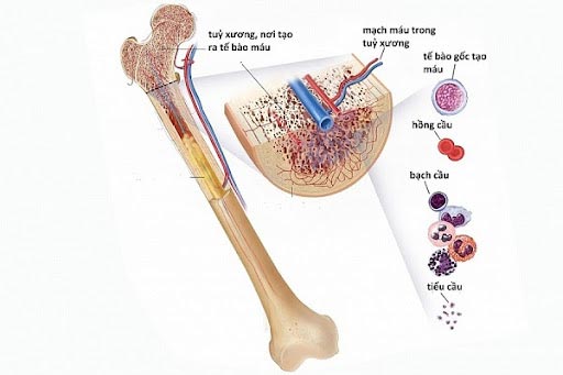 Điều trị suy tuỷ bằng tế bào gốc máu Điều trị suy tuỷ bằng tế bào gốc máu