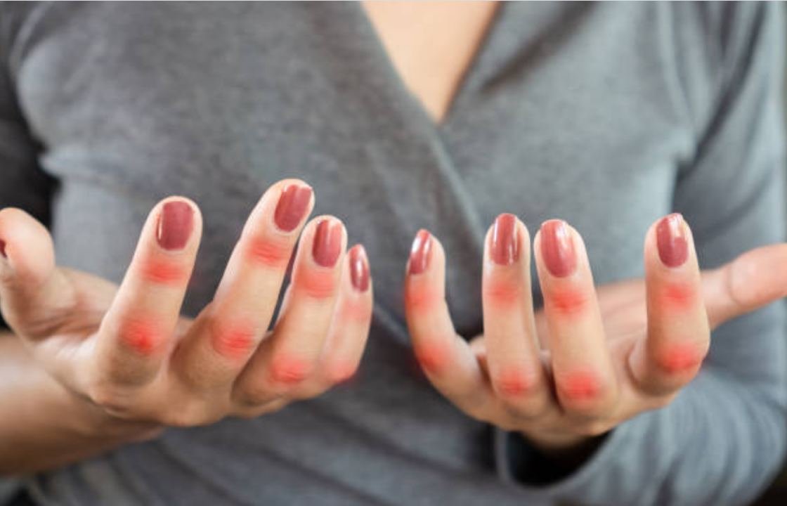 Bệnh Lupus ban đỏ có thể chữa được không? Bệnh Lupus ban đỏ có thể chữa được không?