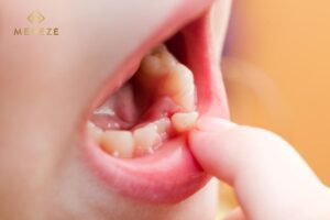 Răng sữa chứa tế bào gốc trung mô