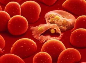 thalassemia