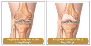 Thoái hoá khớp trước và sau khi điều trị bằng tế bào gốc Medeze