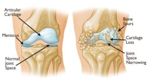 Thoái hóa khớp thường gây ra hiện tượng xương cọ xát vào xương. Còi xương là một đặc điểm chung của dạng viêm khớp này.