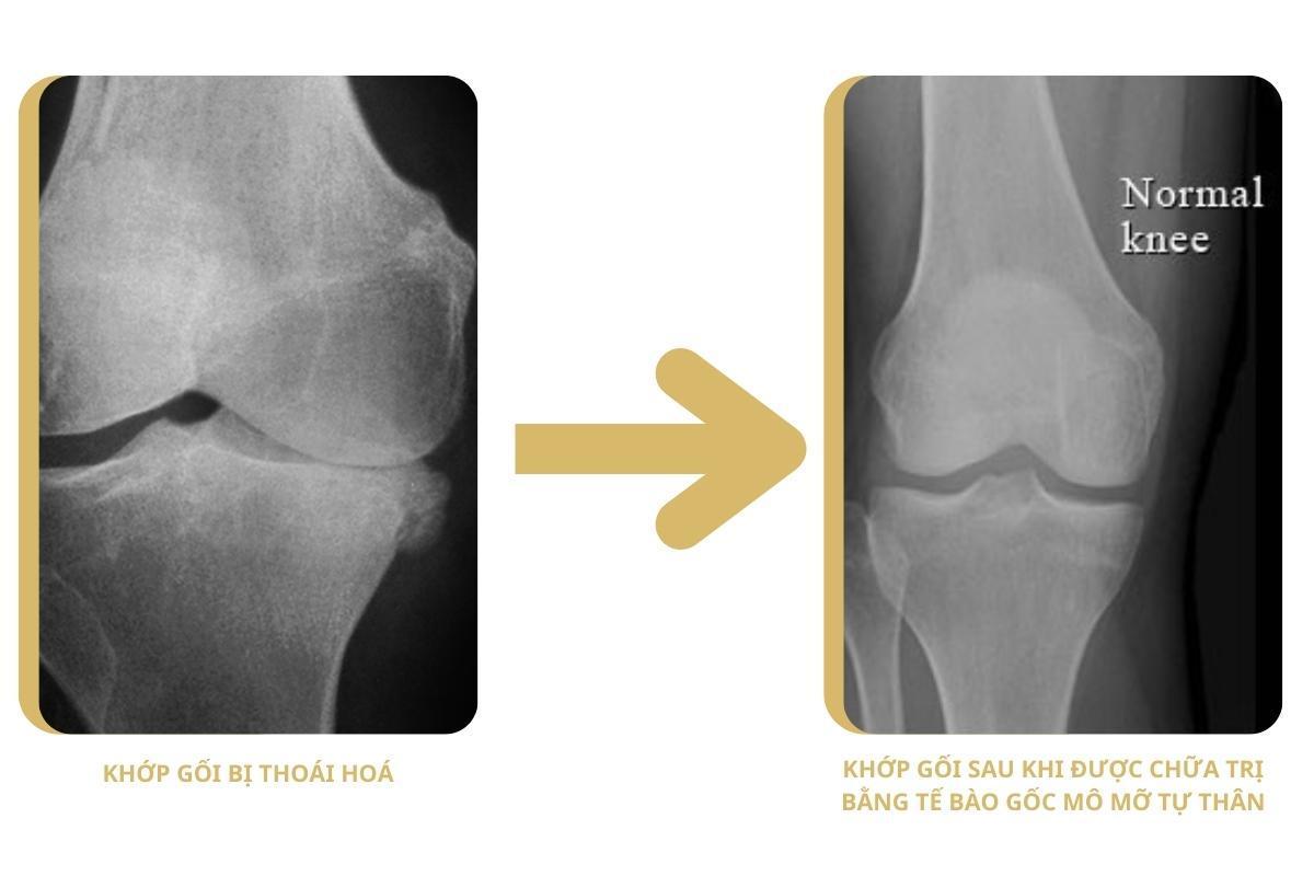 Tế bào gốc từ mô mỡ | Giải pháp cho phục hồi sụn khớp gối tế bào gốc mô mỡ