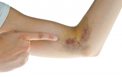 Bệnh nhân ung thư máu ghép tủy sống được bao lâu? Bệnh nhân ung thư máu ghép tủy sống được bao lâu?
