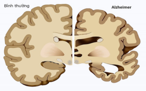 Điều trị bệnh Alzheimer bằng tế bào gốc có lợi ích gì?
