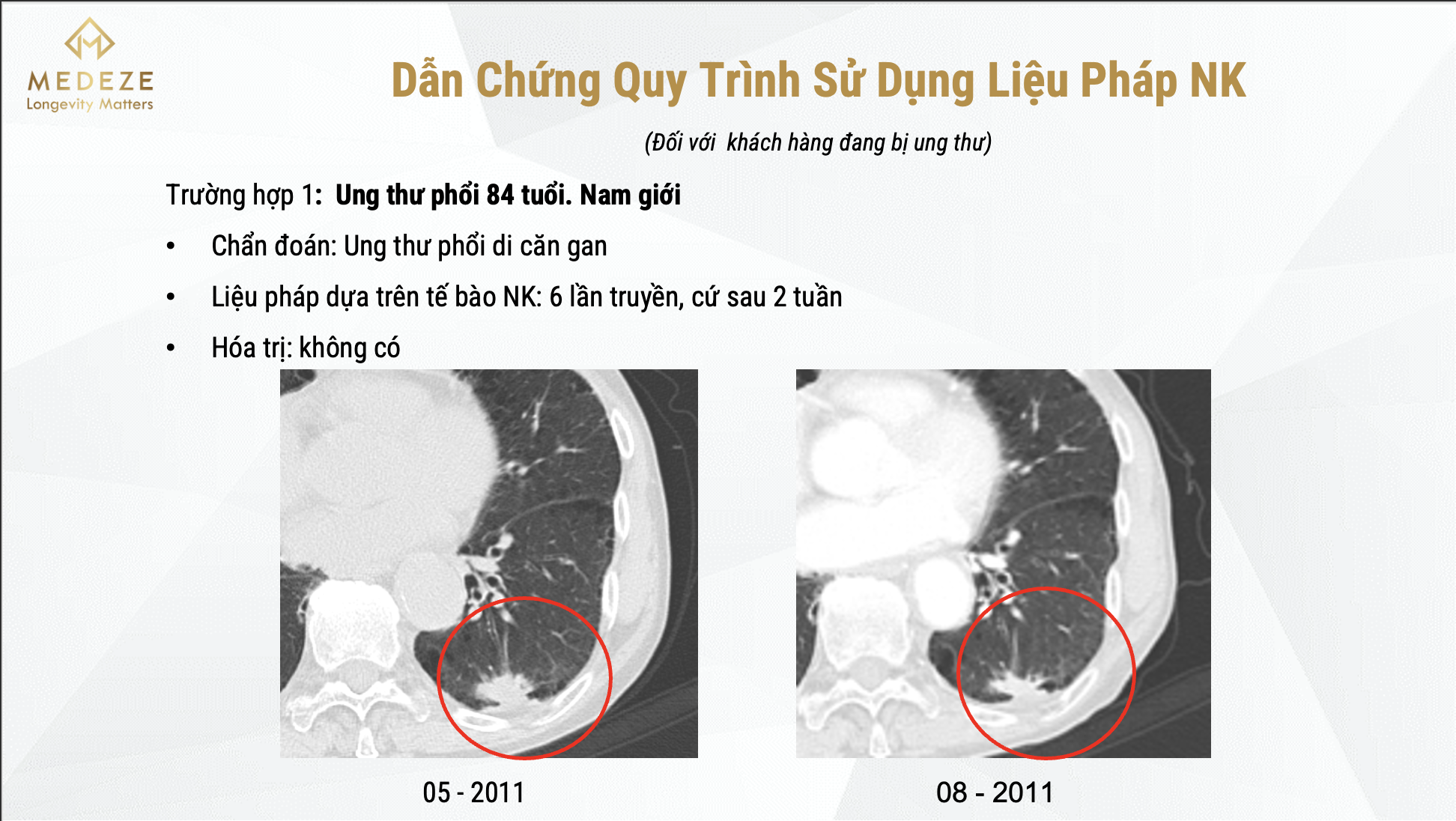 Tập đoàn Medeze mở ra một hướng mới trong điều trị và phòng ngừa ung thư thông qua khả năng miễn dịch cá nhân Tế bào NK Liệu pháp NK điều trị thành công ung thư phổi