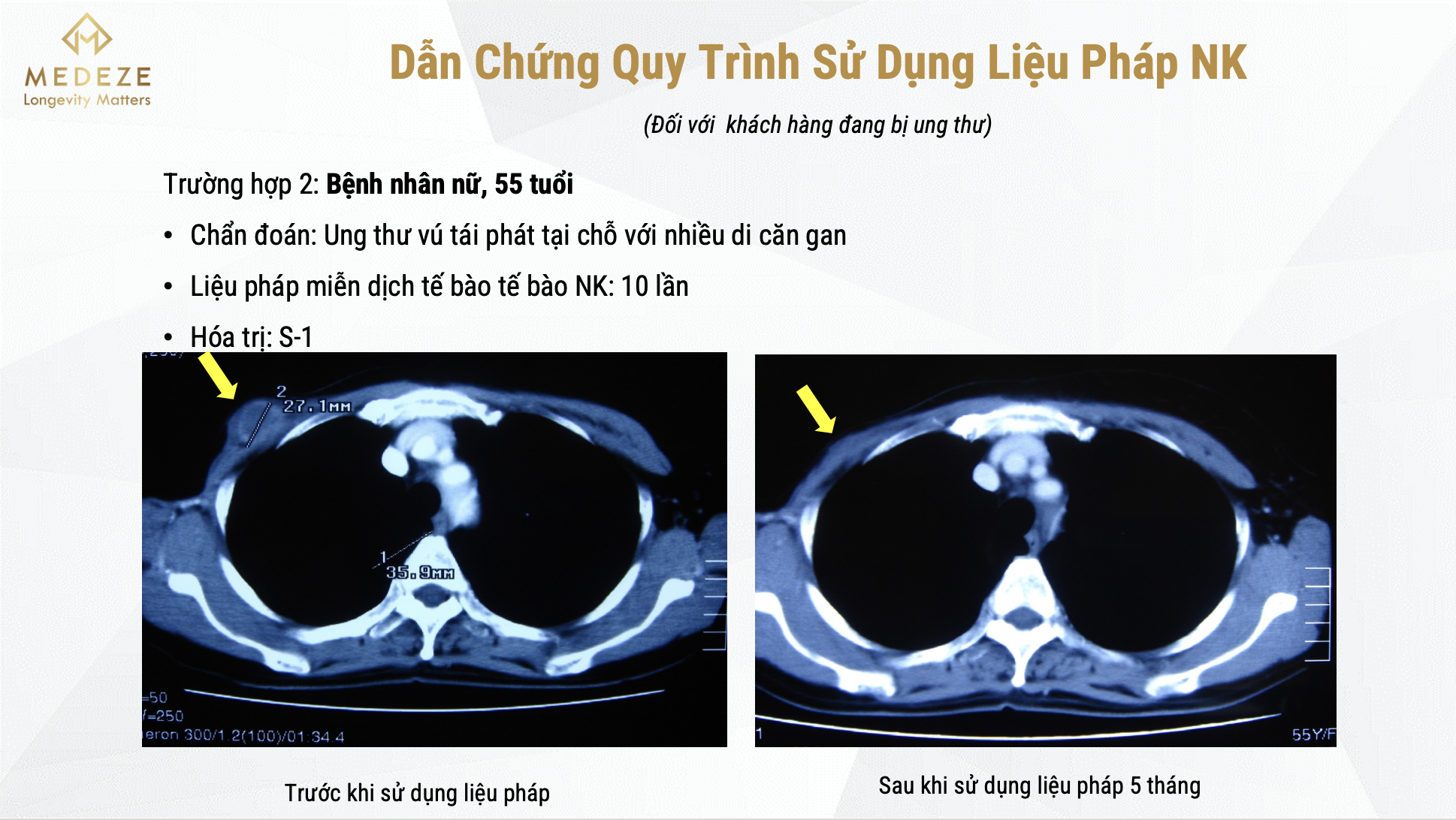 Tập đoàn Medeze mở ra một hướng mới trong điều trị và phòng ngừa ung thư thông qua khả năng miễn dịch cá nhân Tế bào NK Liệu pháp NK điều trị thành công ung thư vú ở phụ nữ