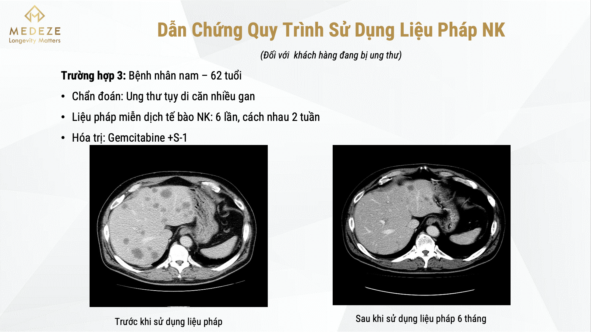 Tập đoàn Medeze mở ra một hướng mới trong điều trị và phòng ngừa ung thư thông qua khả năng miễn dịch cá nhân Tế bào NK Liệu pháp NK điều trị thành công ung thư tuỵ cư căn gan
